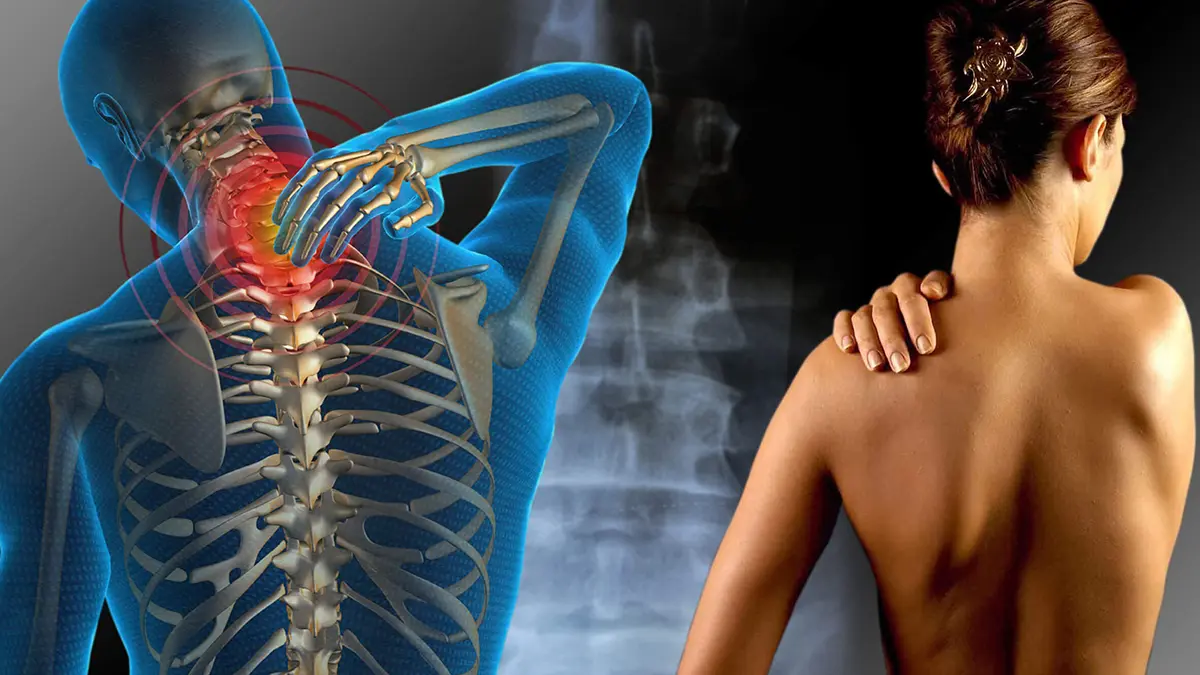 Ilustração de esqueleto com dor na cervical e mulher segurando o ombro com expressão de dor