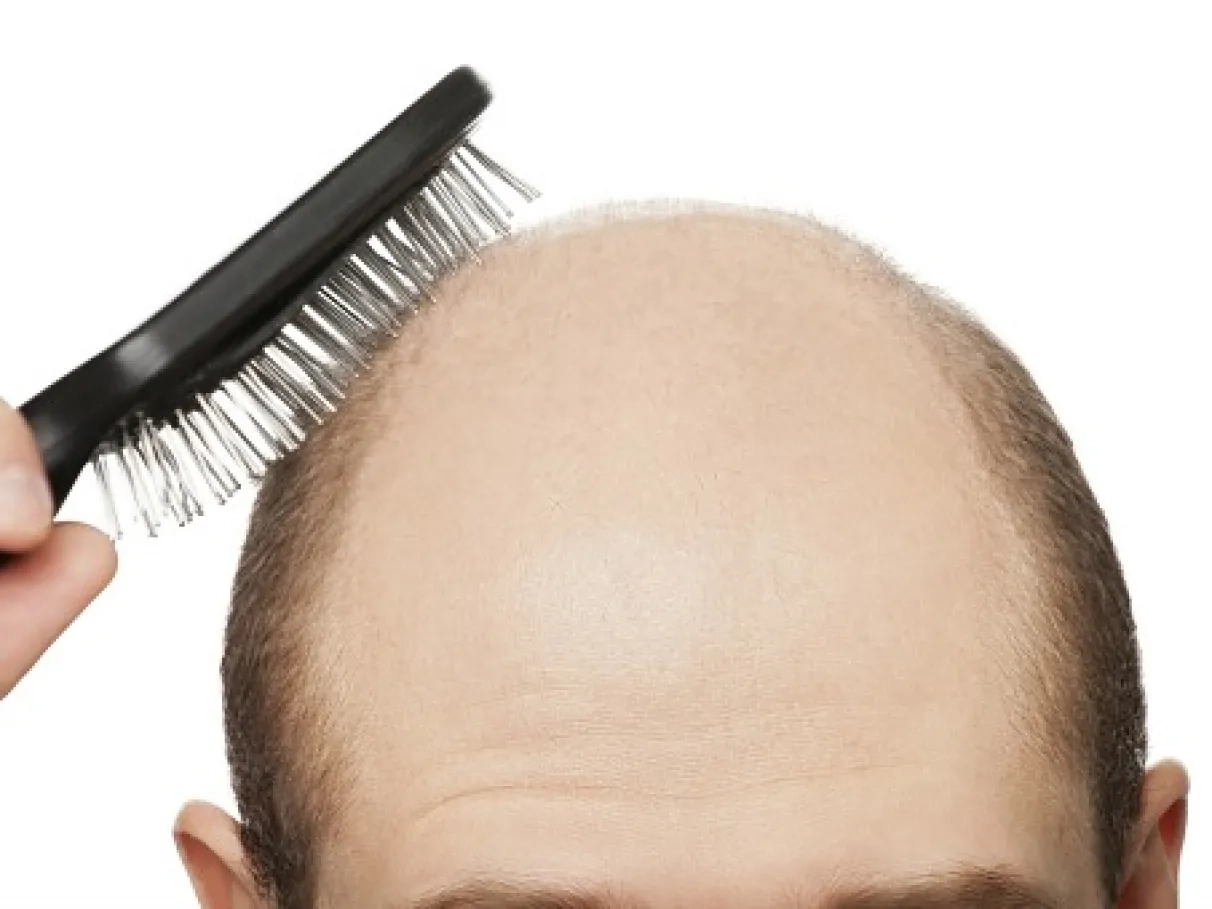 careca-pente-calvicie-original5