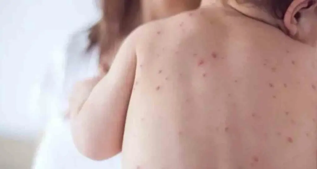 infectologista-alerta-para-a-atualiza-o-das-vacinas-na-preven-o-contra-a-meningite-1024x546