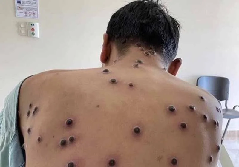 mpox-84294f33