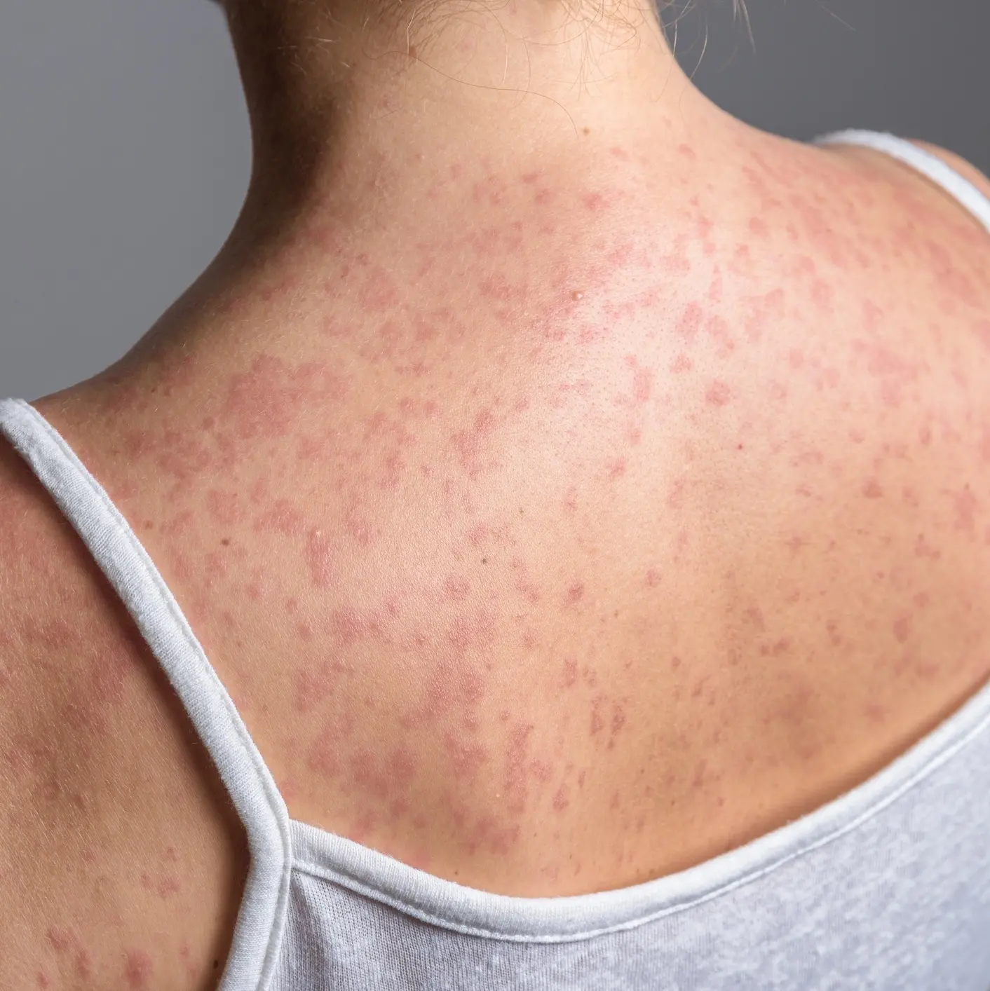 sarampo-e-uma-doenca-extremamente-contagiosa-causada-por-um-virus-1787062390840_v2_1x1