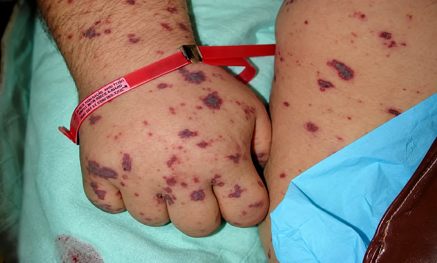 Detalhe de mão, antebraço e parte da perna com manchas avermelhadas e arroxeadas na pele, em ambiente hospitalar