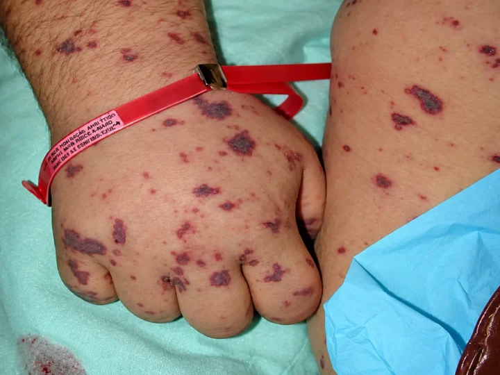 Detalhe de mão, antebraço e parte da perna com manchas avermelhadas e arroxeadas na pele, em ambiente hospitalar